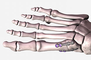 lapiplasty